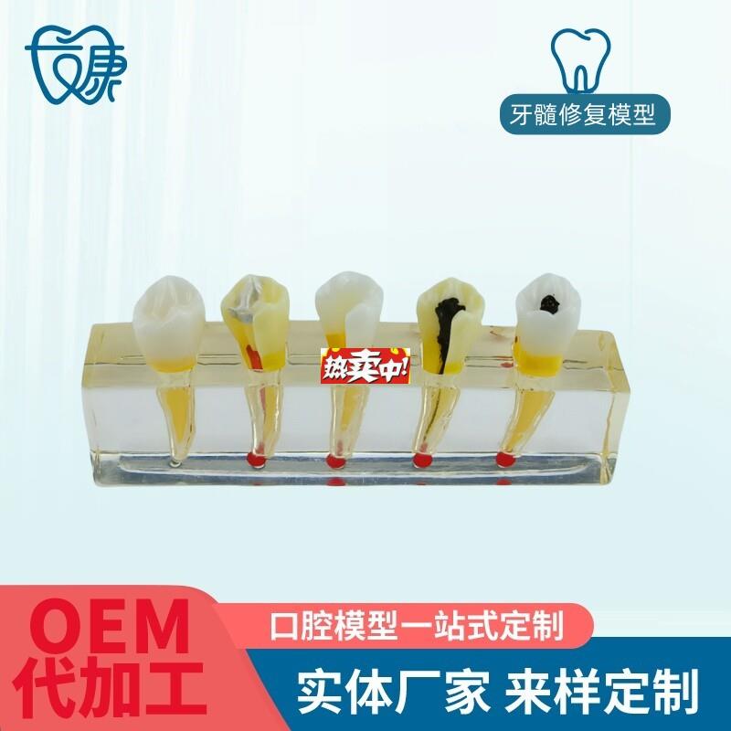 热销牙科医患沟通病理模型牙髓病修复模型展示m牙髓牙髓治疗模