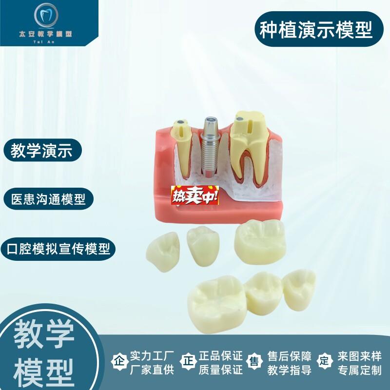 热销牙科口腔种植模型演v示模型医患沟通教学练习种植牙模