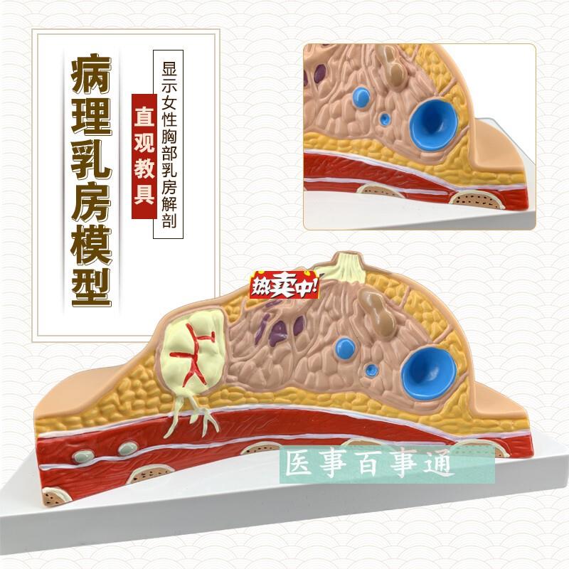 热销正品乳房常见疾病乳房病理解剖结构模型乳房模具t妇科模型包