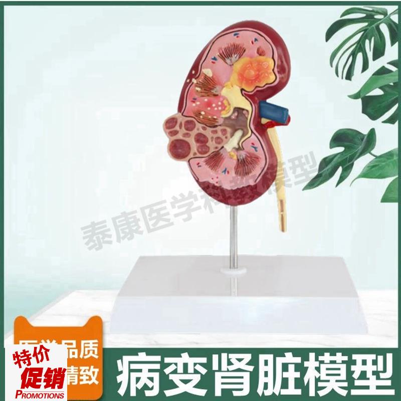 人病理肾脏模型泌尿系统蛋白尿肾小D球肾单位尿液肾上腺内分泌腺