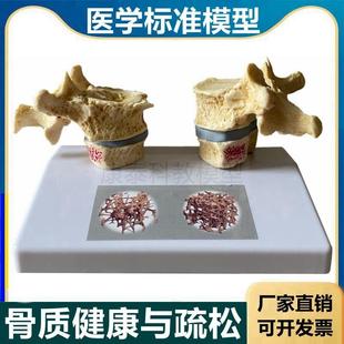骨密度模型骨质结构疏松骨小梁老年骨质变脆病理骨V质医患股骨腰