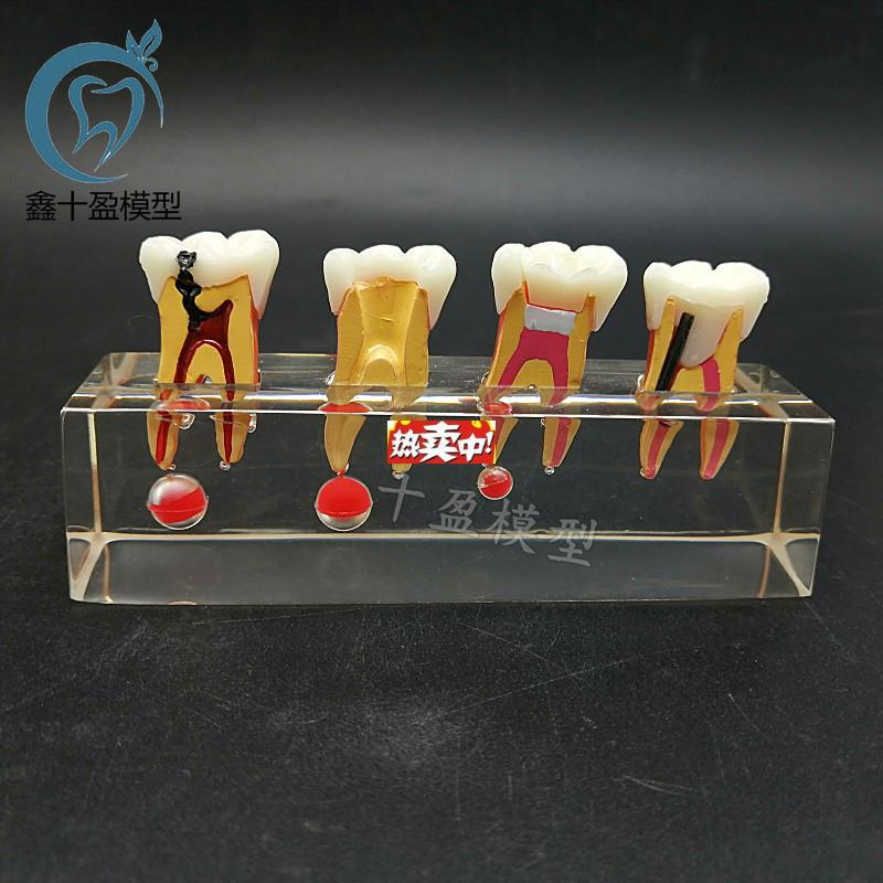 热销牙科教学模型乳牙龋病模型可拆分牙f髓修复医患沟通M4018包