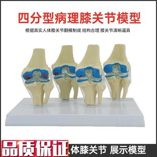 人体四阶段病理膝关节骨骼结构解剖模型病态膝盖R骨质教学骨科展