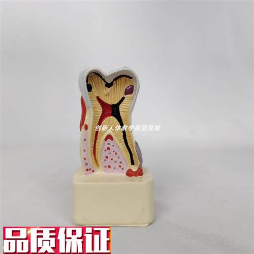 四倍人体牙齿解剖模型牙龈炎蛀y齿蛀牙牙齿出血牙结石切面演示牙