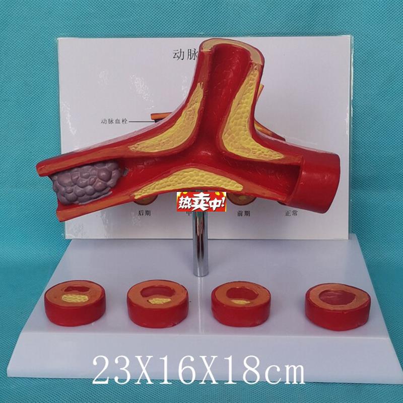 热销人体血管解剖模型病变a血管比较模型医用教学动脉粥