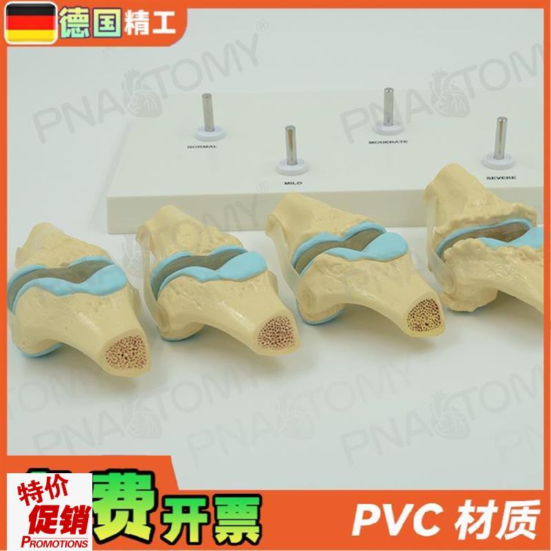 德国】人体膝关节骨骼/病理模型关节骨质/病变教学膝.盖骨外科疼