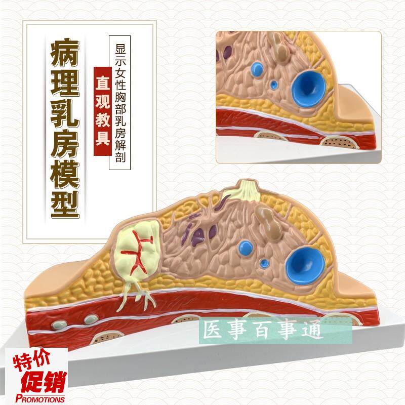 正品乳房常c见疾病乳房病理解剖结构模型乳房模具妇科模型包邮