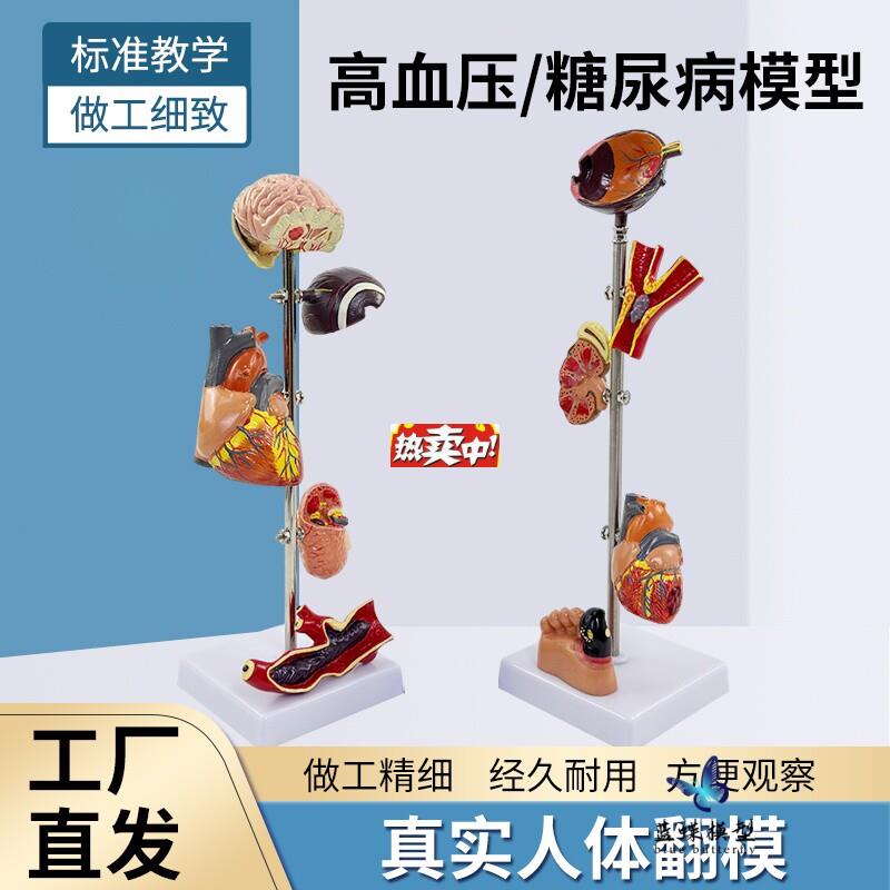 热销糖尿病靶器官模型糖尿病并发症模型H高血压病理模