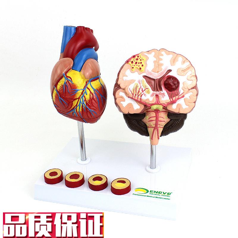 ENOVO颐诺心k脑血管疾病展示模型高血压心脏心血管疾病模型脑