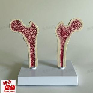 康泰医学模型股i骨密度变化骨质疏松比较长骨干解剖健康病变腿骨