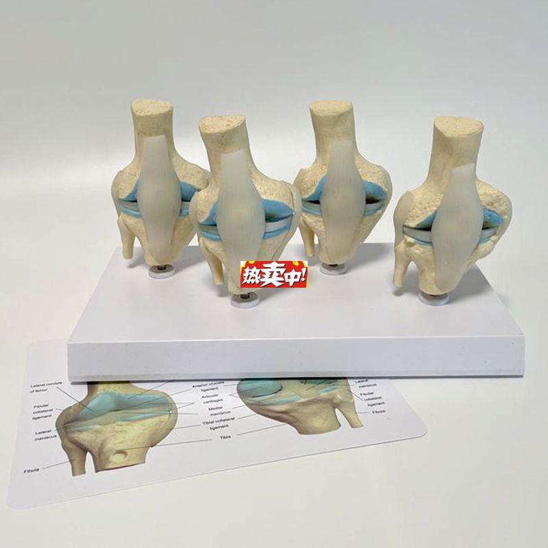 热销膝关节模型半月板软骨骨赘病理膝e盖韧带损伤康复运动骨科医