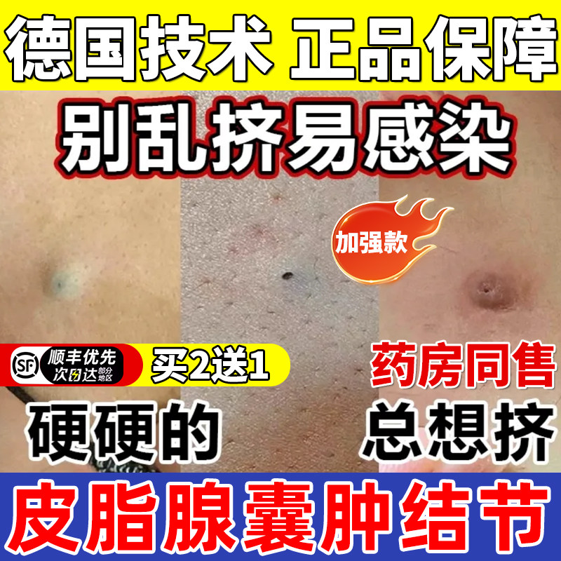 皮脂腺囊肿拔毒拔脓硬块结节黑点头洞坑拔毒拔脓粉瘤粉刺火疖子