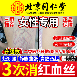 女性腿上有红血丝静脉曲张冷敷凝胶专用腿部修复毛细血管扩张医用