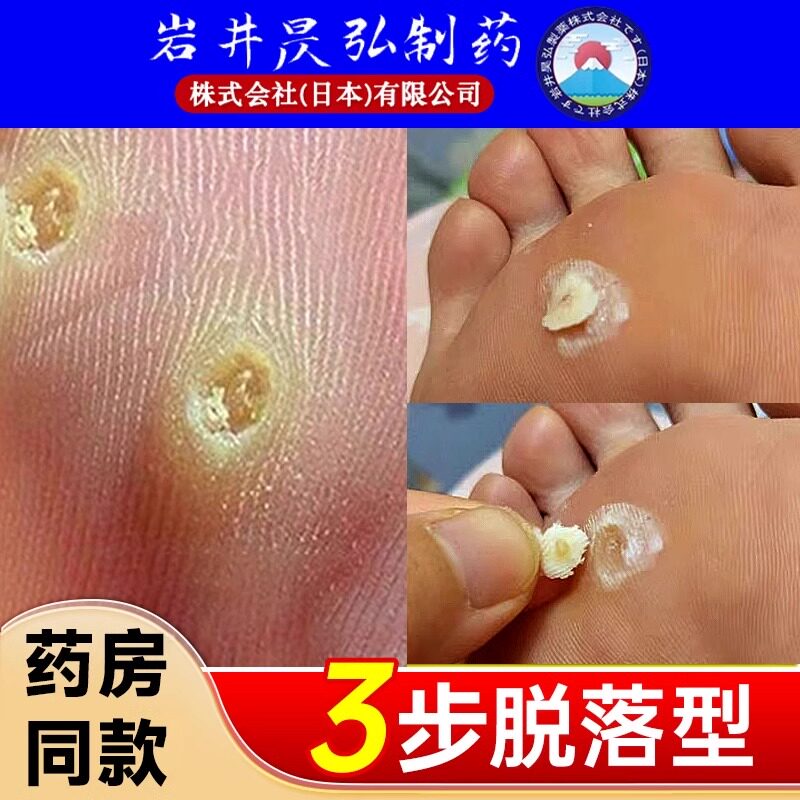 日本鸡眼膏贴药脚垫特效脚底软化肉刺老茧除手足部根脚趾去茧神器