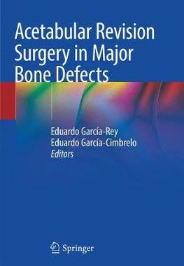 预订 Acetabular Revision Surgery in Major Bone Defects