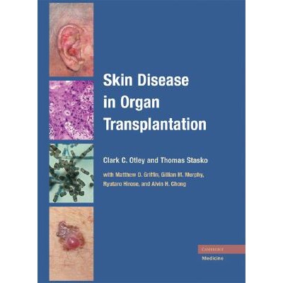 预订 Skin Disease in Organ Transplantation 器官移植中的皮肤疾病 9780521870672