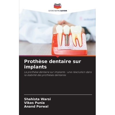 预订 Prothèse dentaire sur implants: La prothèse dentaire sur implants : une révolution dans la stabilité des proth