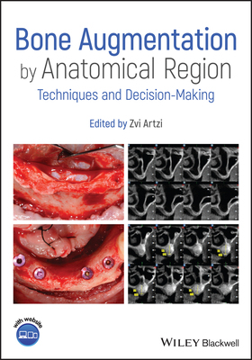 【预订】Bone Augmentation By Anatomical Region - Techniques And Decision-Making