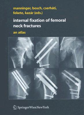 【预订】Internal fixation of femoral neck fractures