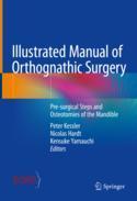 【预订】Illustrated Manual of Orthognathic Surgery: Pre-Surgical Steps and O 9783031069772