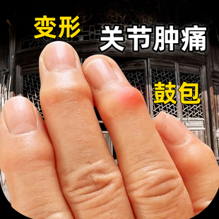 手指关节肿大变形鼓包骨节粗大关节骨痛手指关节变形红肿疼痛专用