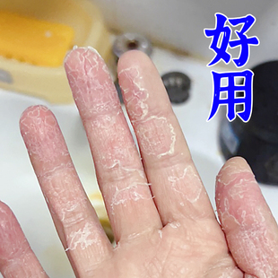 手指脱皮药膏真菌感染治疗手掌脚底手上起皮干燥蜕皮退皮擦用什么