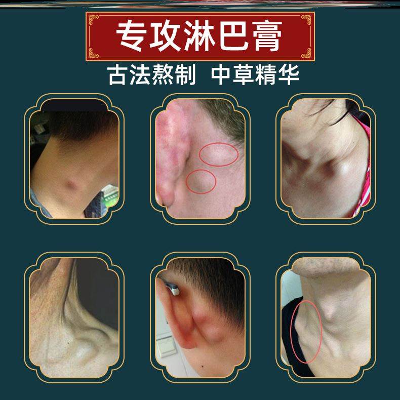 结节膏消除甲状腺膏肺玻璃磨微小淋巴水肿压力弹力手套散结膏