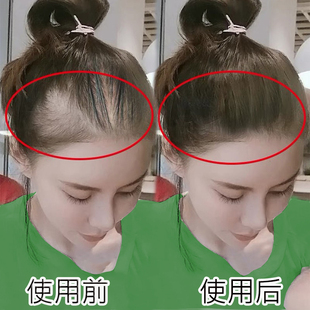 13天防脱育发】万发皆可生 发量蹭蹭涨 无发缝 不掉发更浓密 2发3