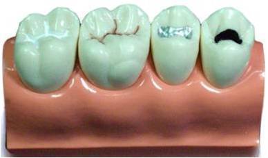 ENOVO颐诺牙齿窝沟封闭模型 口腔科牙体制备教学模型 口腔模型