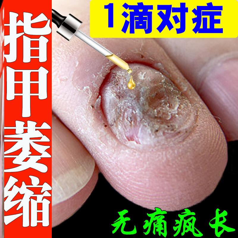 指甲萎缩甲床修复生长液指甲受损分层萎缩断裂指甲短小凹凸不平