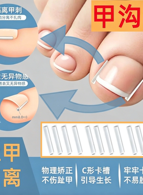 嵌甲矫正贴甲沟填充垫片指甲扎肉阻止往肉里长专用矫正专用工具