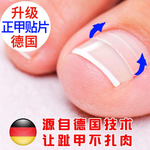 正甲贴脚趾甲卷嵌甲甲沟矫正器指甲长肉里专用修脚拉拉炎贴片神器