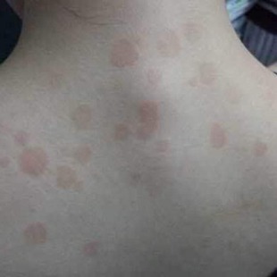 汗斑专用药汗斑净皮肤日本汗斑露汉斑专用药灵花斑藓膏外用搽剂