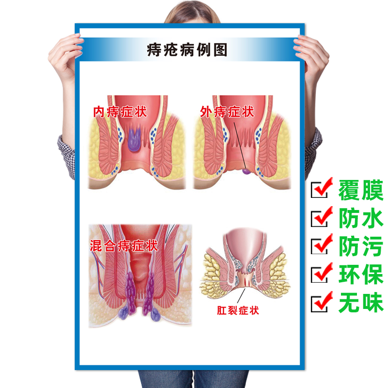 医院肛肠科知识宣传海报 肛肠科痔疮病症图谱简介挂图 肛门健康画