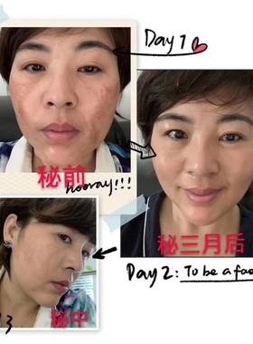 秘制早晚霜淡化妊娠老年斑