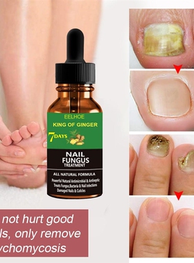 Professional Nail Repair Liquid Fungal Cure Nail Fungus Remo