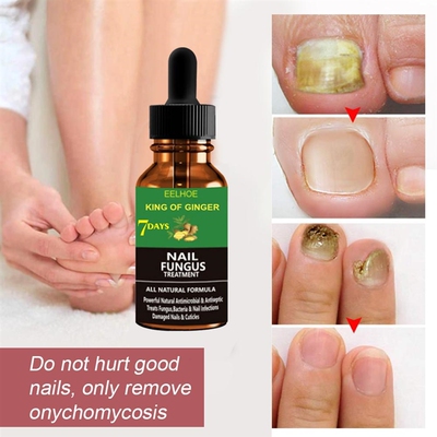 Professional Nail Repair Liquid Fungal Cure Nail Fungus Remo