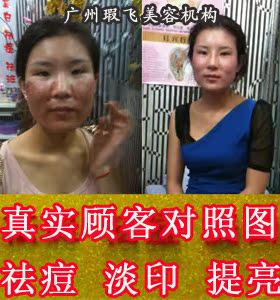3号中草本去印醋疗暗疮面膜粉