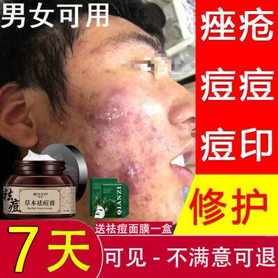 痤疮膏祛痘重度暗疮印脸部下巴淋巴腮边痘青春去豆豆正品草本修护