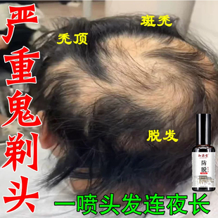 米诺地尔片诚悦非那雄胺片诚悦非那雄胺保法止雄性激素脱发