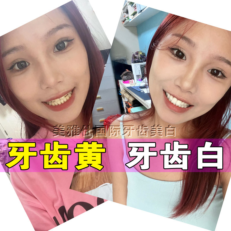美雅仕私人定制牙齿美白剂凝胶使天生内源黄牙齿变白神器非美牙贴