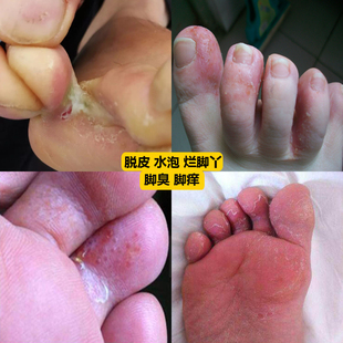 脚脱皮脚痒脚指缝开裂脚趾脚后跟密集小水泡烂脚丫专用膏喷雾剂