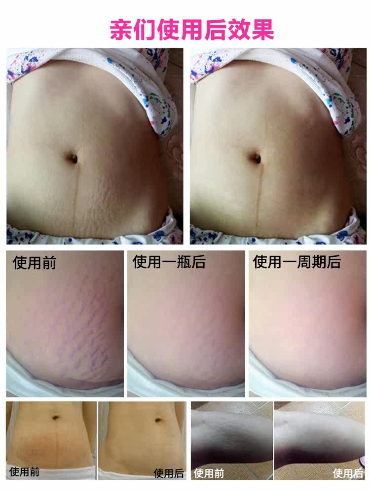 [咕咪薇薇妊娠纹护理]蔓舞去妊娠修复霜产前肥胖纹孕妇专用产月销量0件仅售67.2元