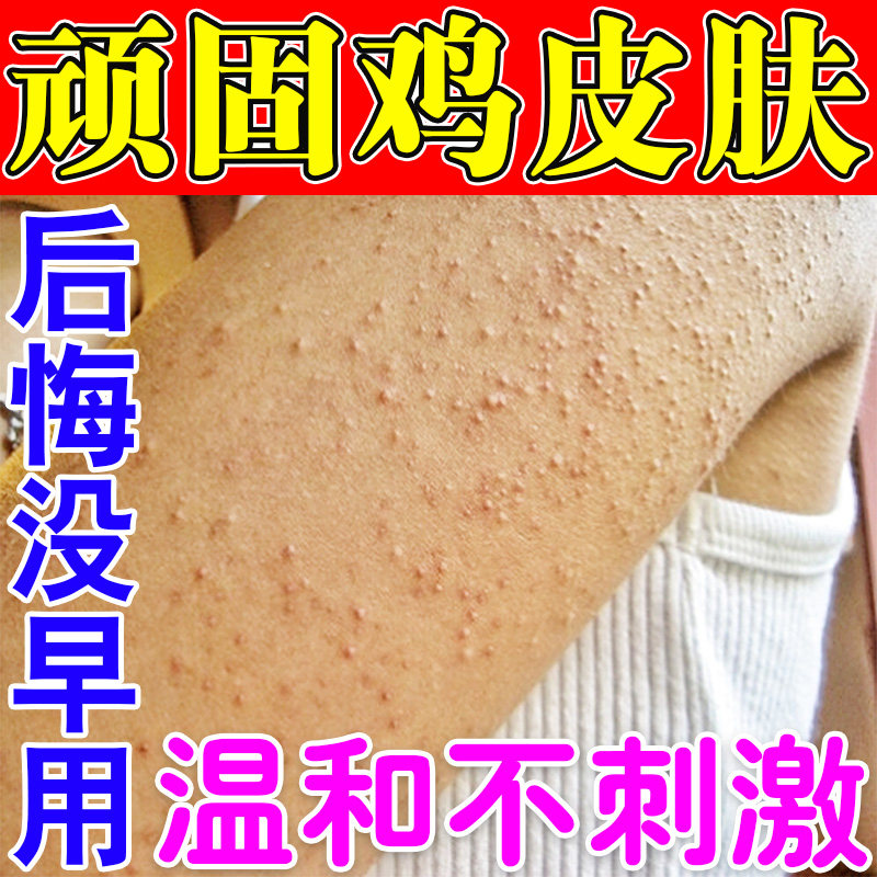 胳膊鸡皮肤疙瘩毛囊毛周角化去除症手臂脸上腿部药胳膊红点黑点膏