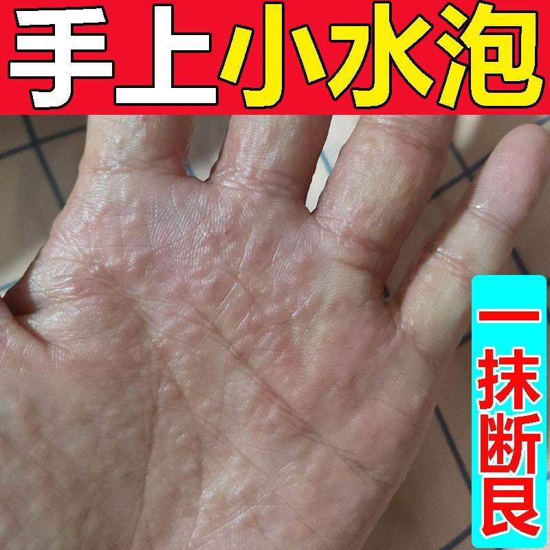 去手上小水泡药膏手痒脱皮干裂皮肤过敏汗疱泡疹止痒真菌感染乳膏