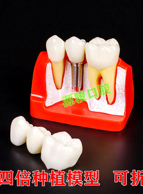 牙科4倍种植解模型 可拆卸 连桥牙冠 种植钉 演示种植修复牙模