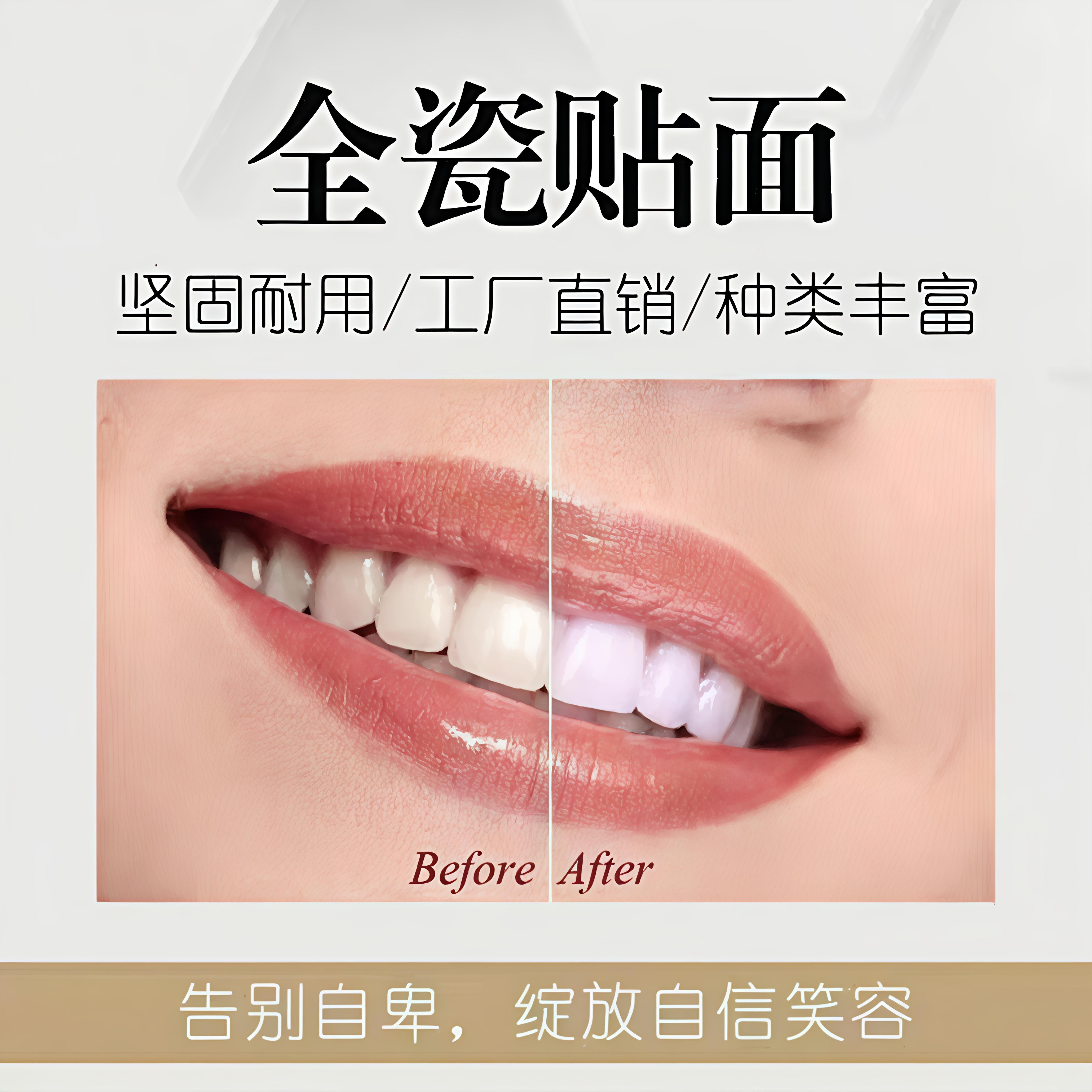 手工瓷贴面全瓷贴片全瓷牙贴面玻璃瓷贴面手工瓷贴片牙美白贴面