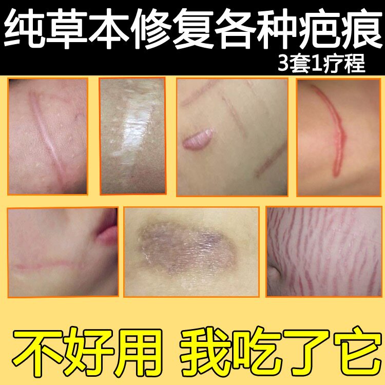 [喜阳春商城淡疤护理]美肤疤痕霜祛 疤膏淡化妊娠纹修复膏去月销量0件仅售58元