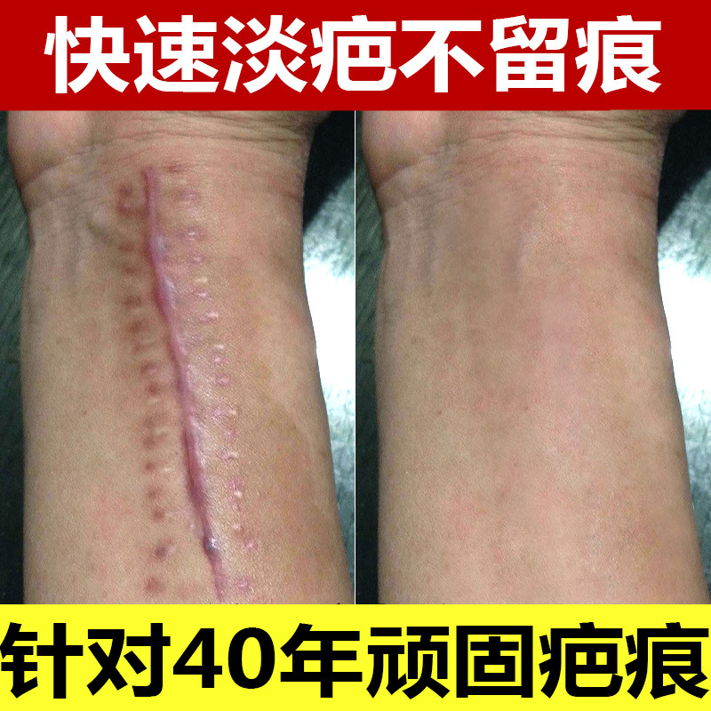 [喜阳春商城淡疤护理]薰衣草祛 疤痕精品组合祛 疤膏去 疤月销量0件仅售89元