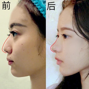草本鼻梁挺直精华 挺翘直鼻立体美鼻精油加强版